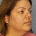 Liposuction of the Neck Before & After Patient #12093