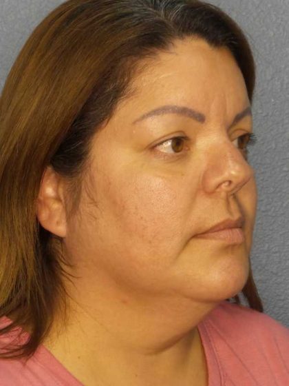 Liposuction of the Neck Before & After Patient #12093