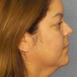 Liposuction of the Neck Before & After Patient #12093