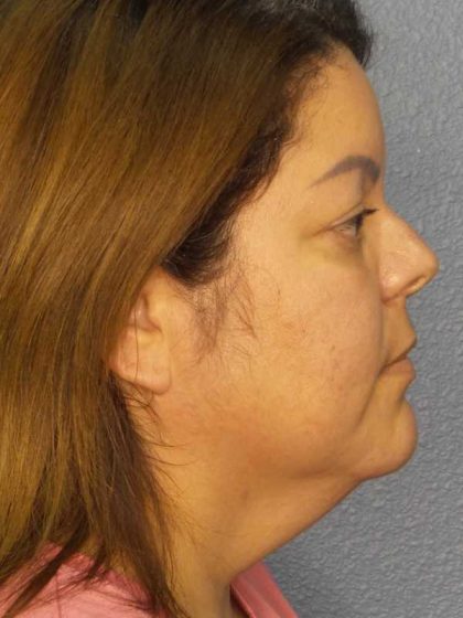 Liposuction of the Neck Before & After Patient #12093