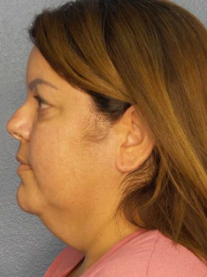 Liposuction of the Neck Before & After Patient #12093