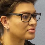 Liposuction of the Neck Before & After Patient #12020