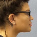 Liposuction of the Neck Before & After Patient #12020