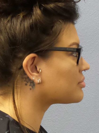 Liposuction of the Neck Before & After Patient #12020