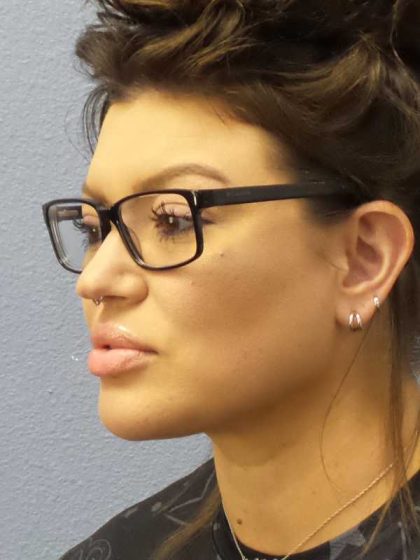 Liposuction of the Neck Before & After Patient #12020