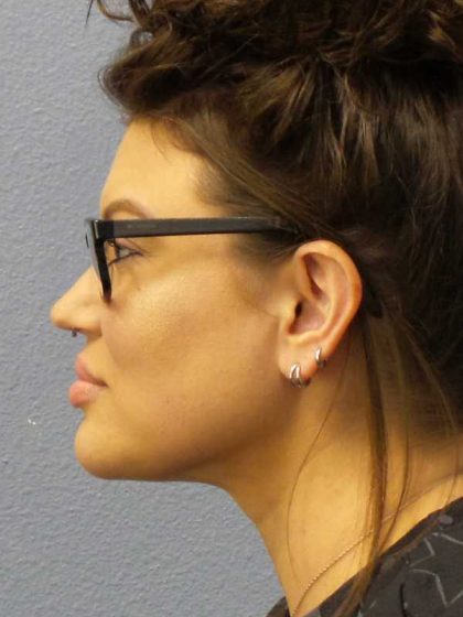 Liposuction of the Neck Before & After Patient #12020