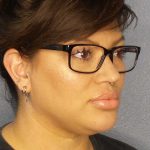 Liposuction of the Neck Before & After Patient #12020