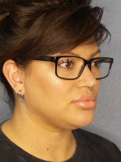 Liposuction of the Neck Before & After Patient #12020