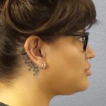 Liposuction of the Neck Before & After Patient #12020
