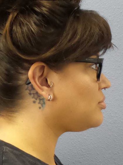Liposuction of the Neck Before & After Patient #12020