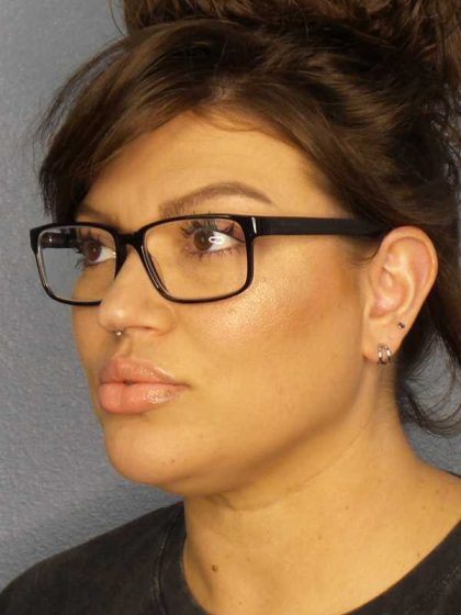Liposuction of the Neck Before & After Patient #12020