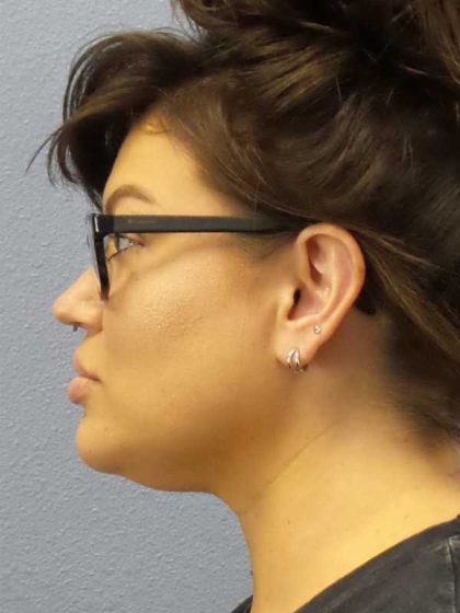 Liposuction of the Neck Before & After Patient #12020