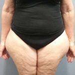 Liposuction Female Before & After Patient #7808