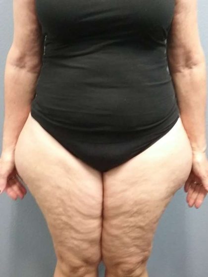 Liposuction Female Before & After Patient #7808