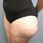 Liposuction Female Before & After Patient #7808