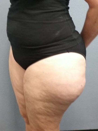 Liposuction Female Before & After Patient #7808