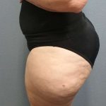 Liposuction Female Before & After Patient #7808