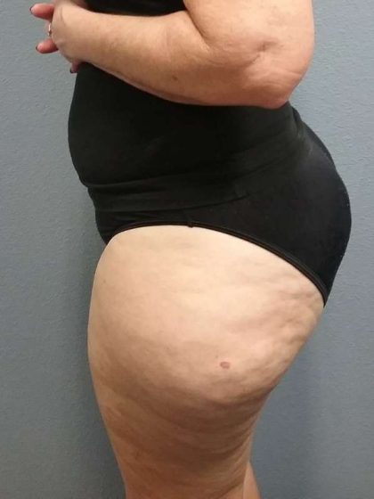 Liposuction Female Before & After Patient #7808