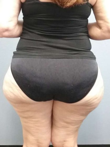 Liposuction Female Before & After Patient #7808