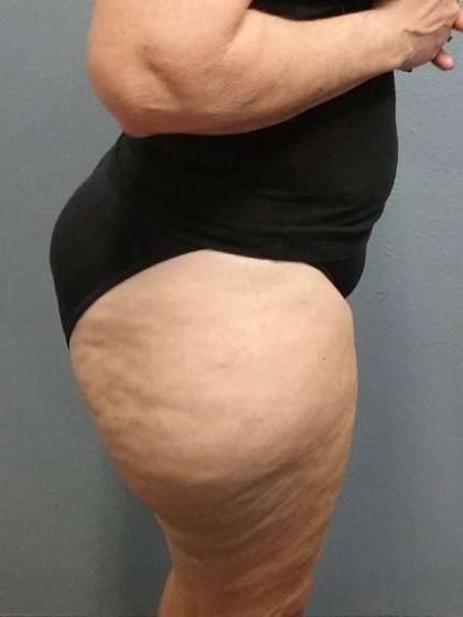 Liposuction Female Before & After Patient #7808