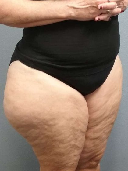 Liposuction Female Before & After Patient #7808