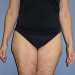 Liposuction Female Before & After Patient #7808