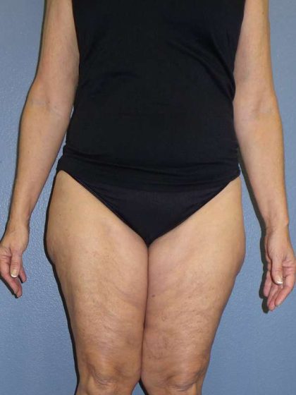 Liposuction Female Before & After Patient #7808