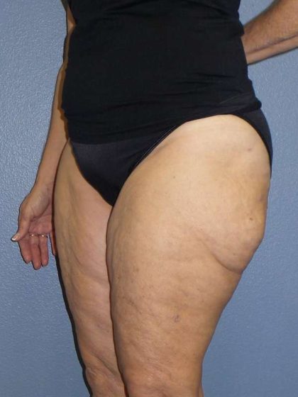 Liposuction Female Before & After Patient #7808
