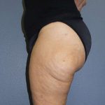 Liposuction Female Before & After Patient #7808