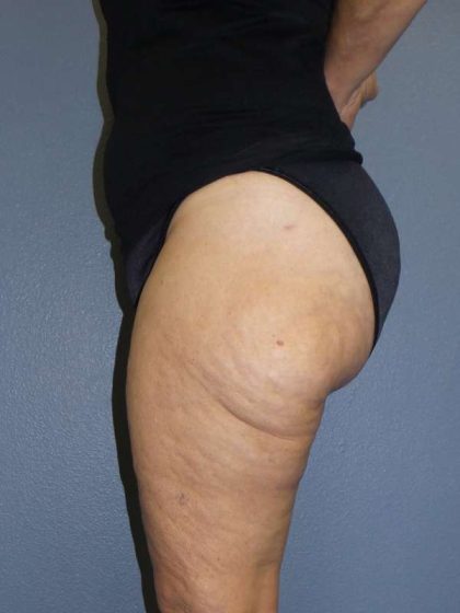 Liposuction Female Before & After Patient #7808