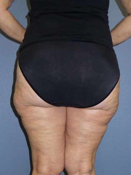 Liposuction Female Before & After Patient #7808