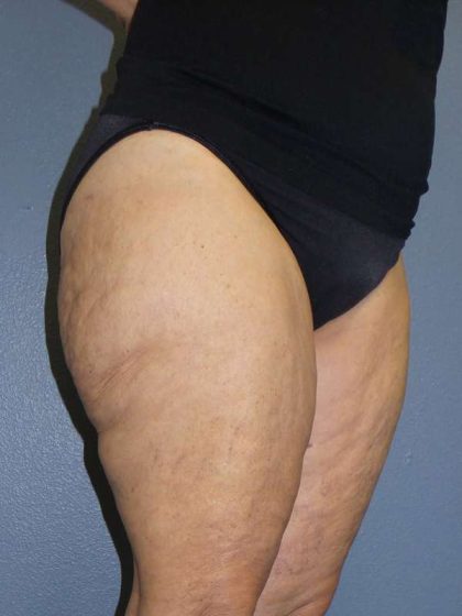 Liposuction Female Before & After Patient #7808