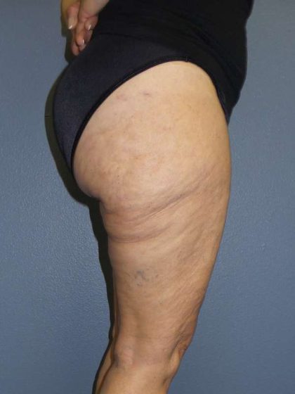 Liposuction Female Before & After Patient #7808