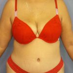 Brazilian Butt Lift Before & After Patient #4856