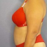 Brazilian Butt Lift Before & After Patient #4856