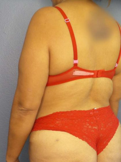 Brazilian Butt Lift Before & After Patient #4856