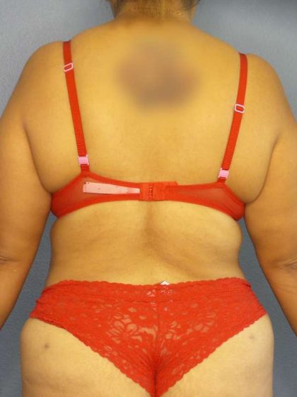 Brazilian Butt Lift Before & After Patient #4856