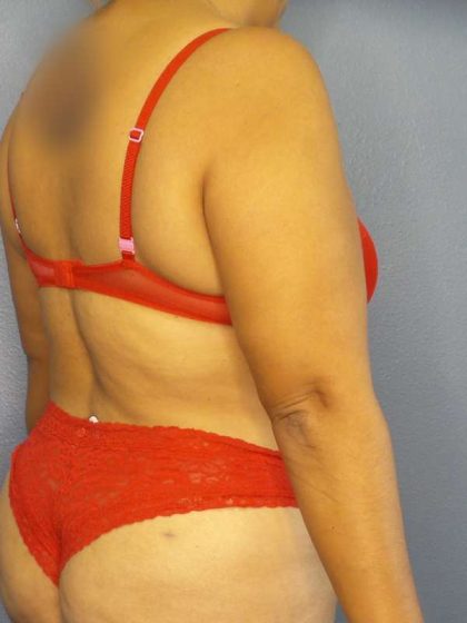 Brazilian Butt Lift Before & After Patient #4856
