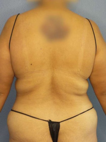 Brazilian Butt Lift Before & After Patient #4856