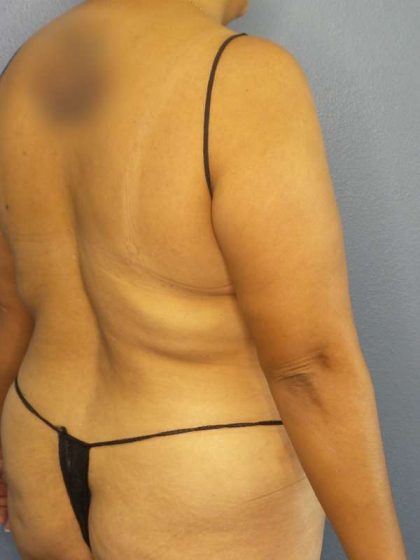 Brazilian Butt Lift Before & After Patient #4856