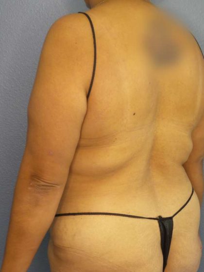 Brazilian Butt Lift Before & After Patient #4856