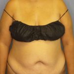 Brazilian Butt Lift Before & After Patient #4856