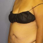 Brazilian Butt Lift Before & After Patient #4856