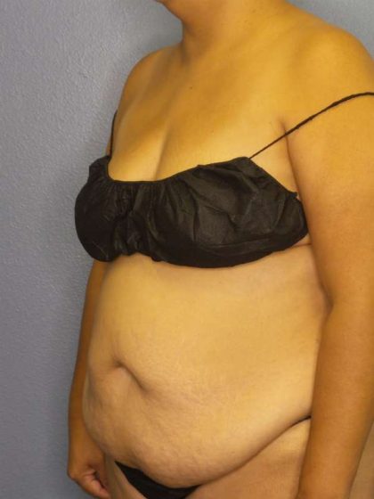 Brazilian Butt Lift Before & After Patient #4856