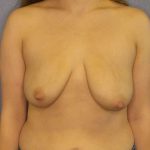 Breast Lift with Implant (Augmentation Mastopexy) Before & After Patient #4498