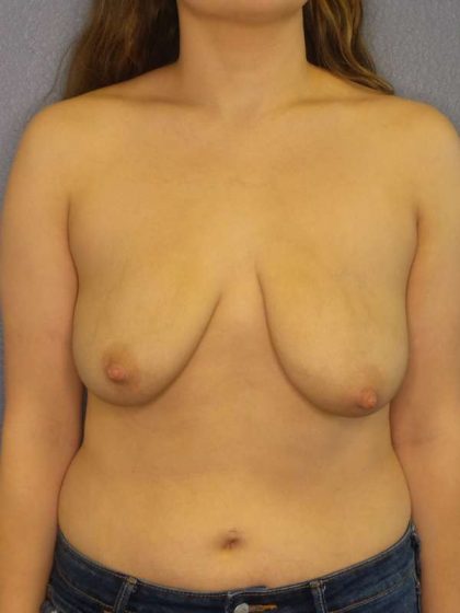 Breast Lift with Implant (Augmentation Mastopexy) Before & After Patient #4498