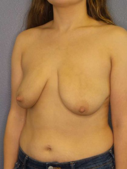Breast Lift with Implant (Augmentation Mastopexy) Before & After Patient #4498