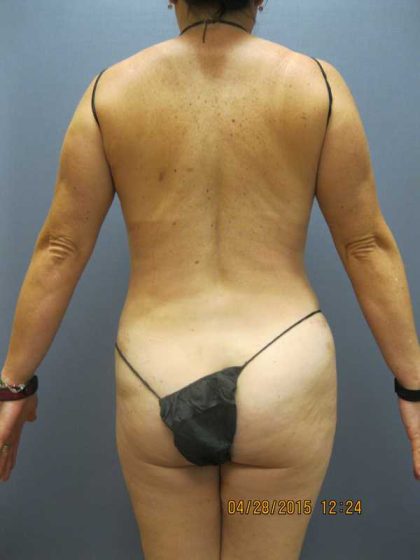 Liposuction Female Before & After Patient #7737