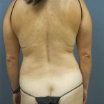 Liposuction Female Before & After Patient #7737