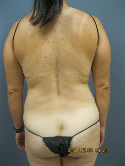 Liposuction Female Before & After Patient #7737